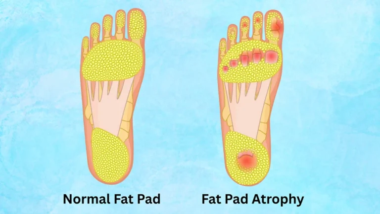 Walking on Bone? Understanding Fat Pad Loss and Foot Pain