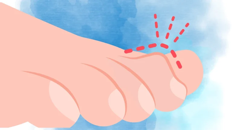 Ditch the Fear Factor: Treat Hammertoes with Tiny Incisions, Not Big Scars!