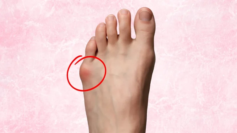 Revolutionary Treatments for Tailor’s Bunions: Is Minimally Invasive Surgery Right for You?